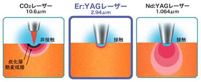 CvgEr:YAG[U[̓